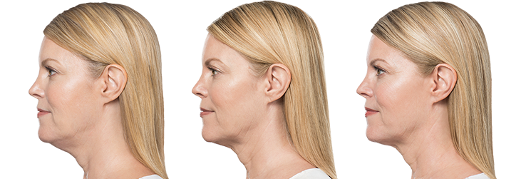 KYBELLA® Before And After | KYBELLA®