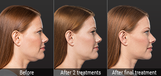Kybella Before + After Photos - Purely Aesthetics